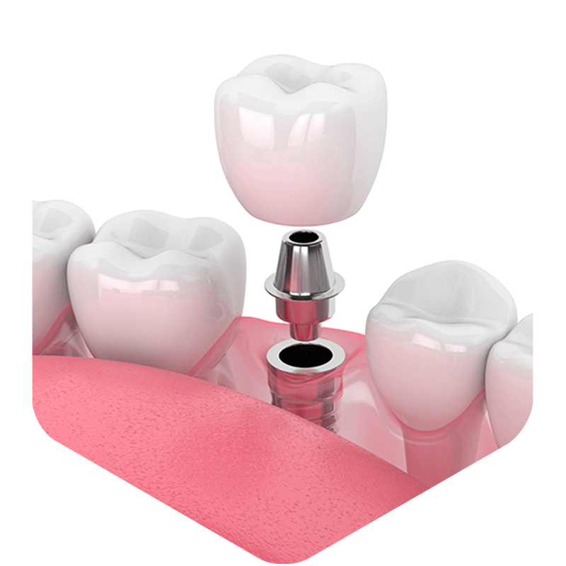 Illustration of dental implants